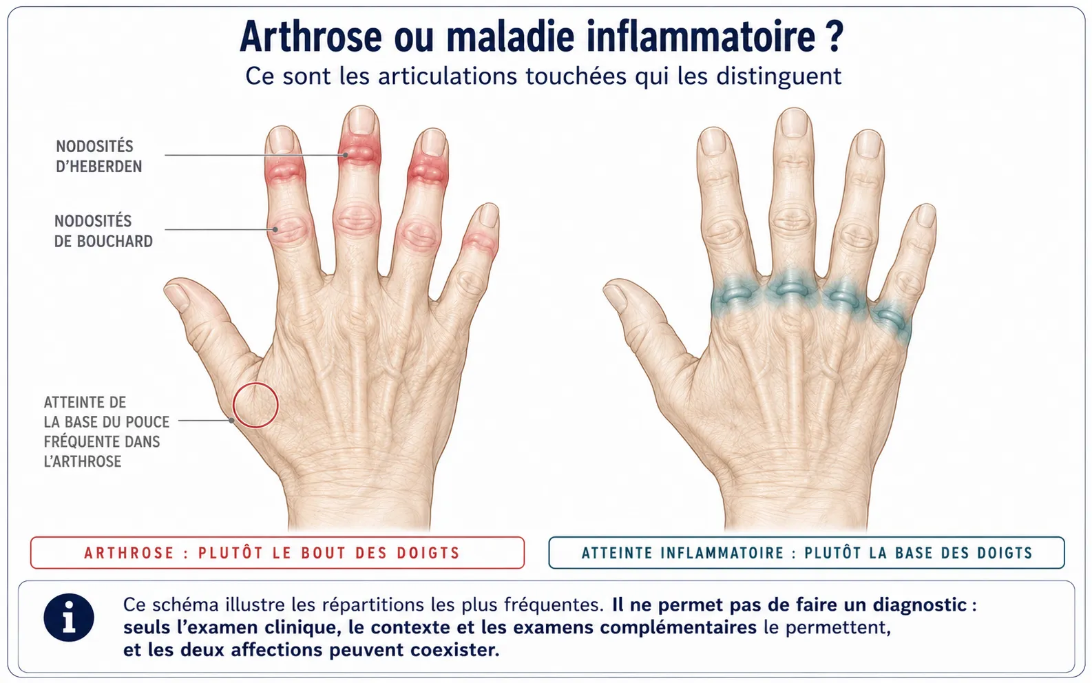 Arthrose des doigts — illustration médicale