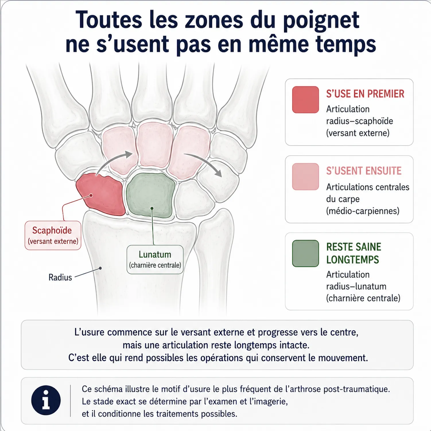 Arthrose du poignet — illustration médicale