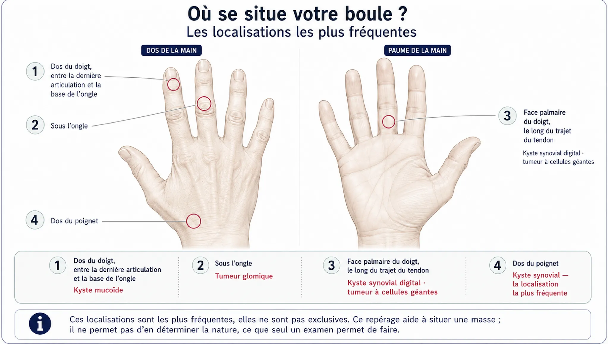 Boules et kystes des doigts — illustration médicale