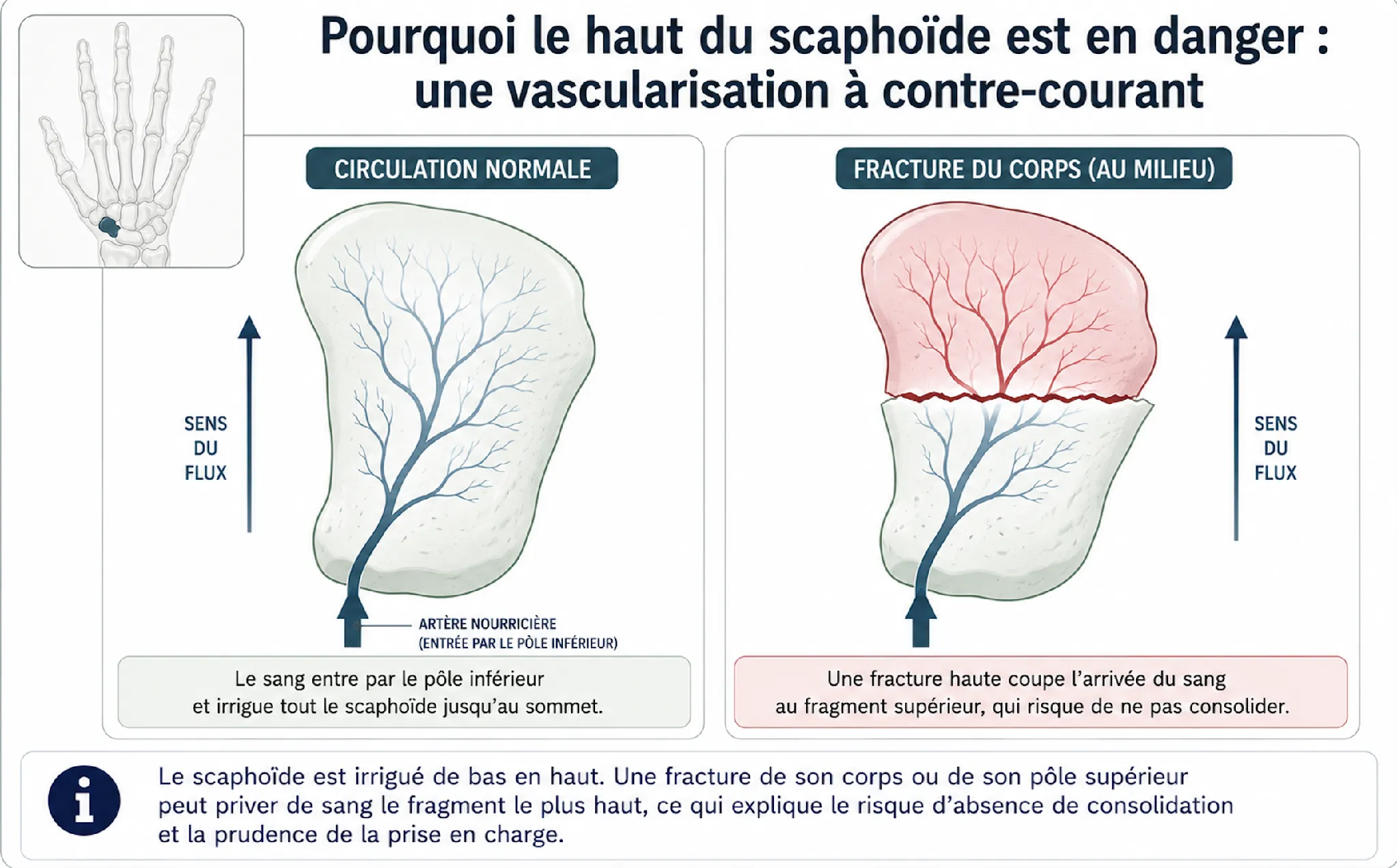 Fracture du scaphoïde — illustration médicale
