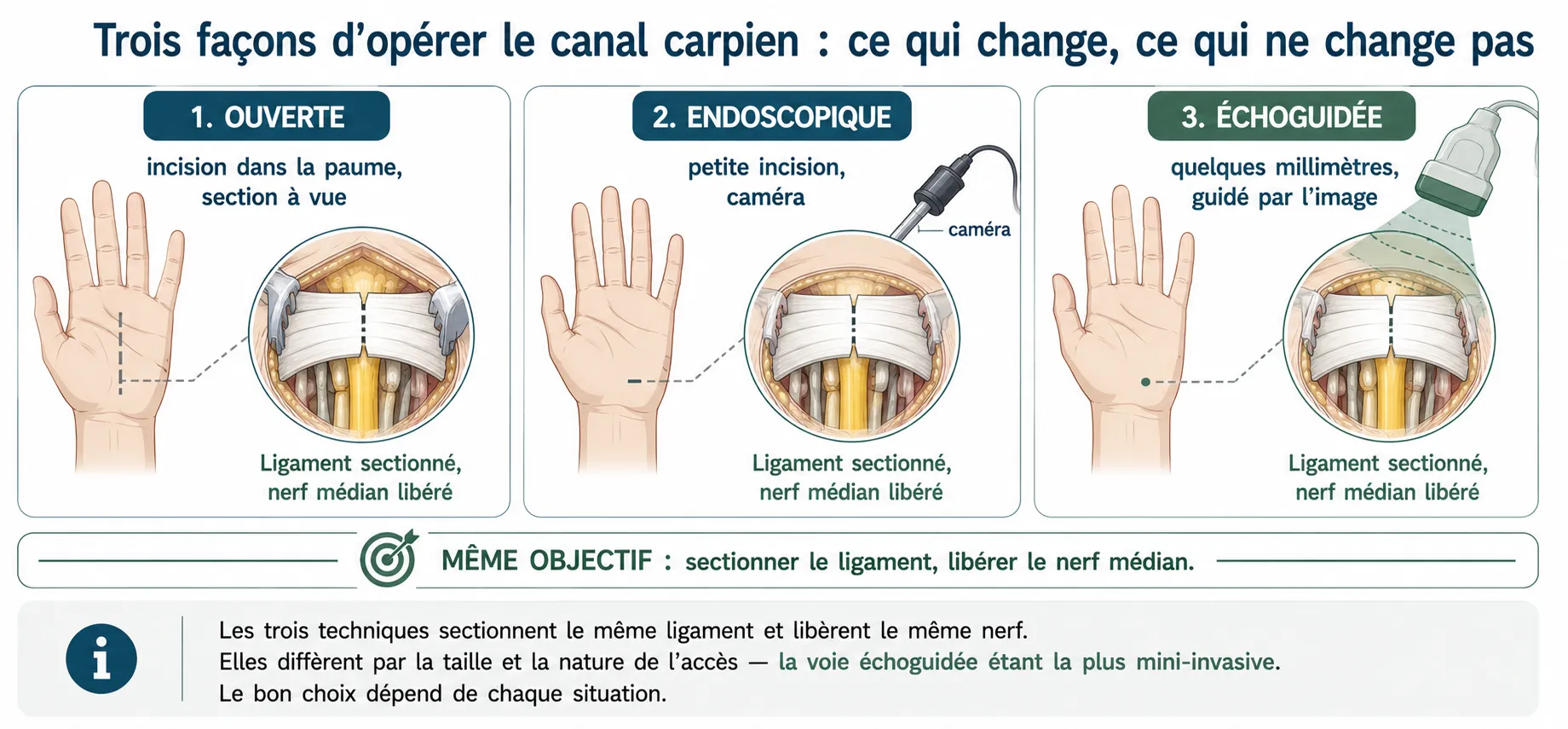 L'opération du canal carpien micro-invasive — illustration médicale
