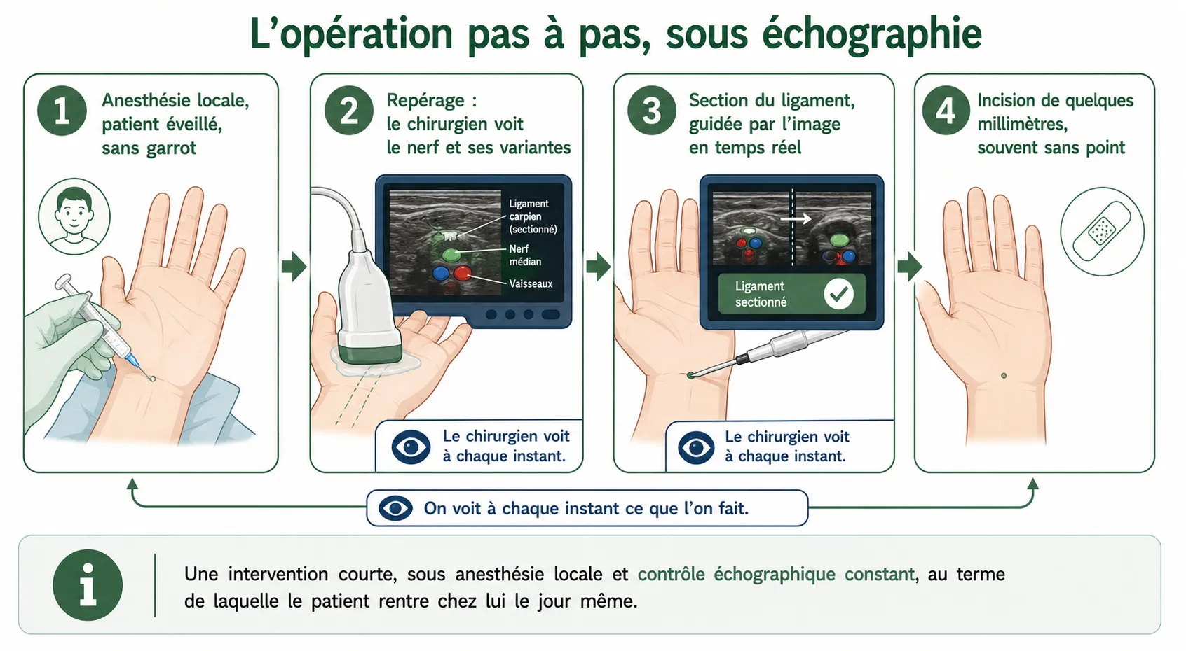 L'opération du canal carpien micro-invasive — illustration médicale