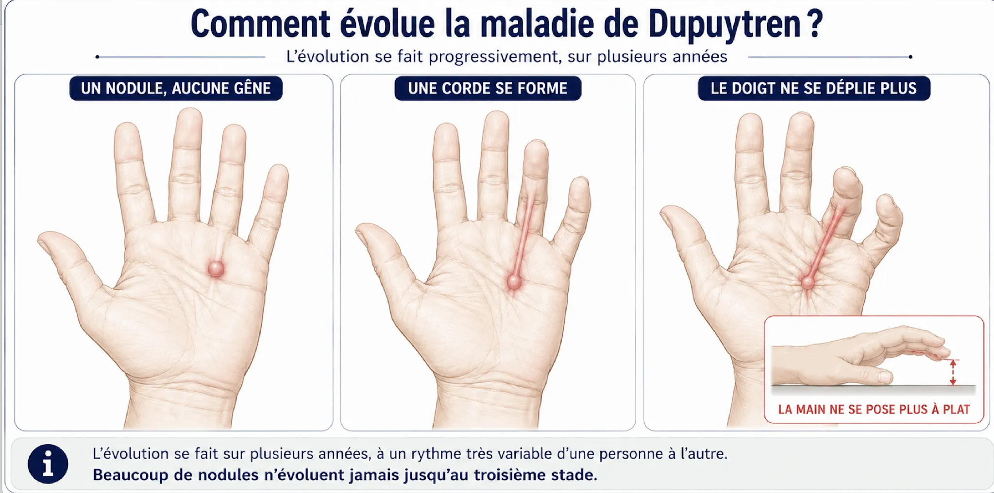Maladie de Dupuytren — illustration médicale