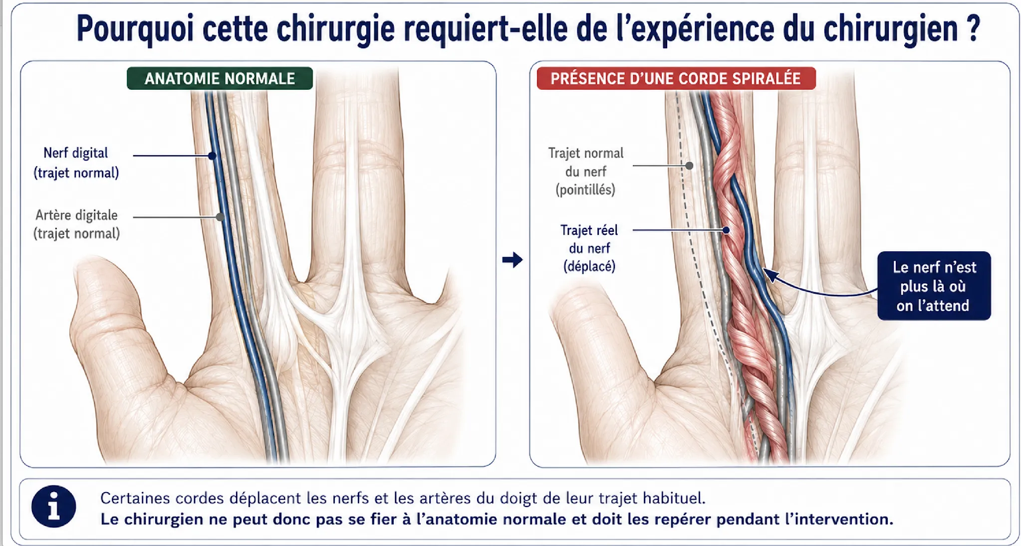 Maladie de Dupuytren — illustration médicale