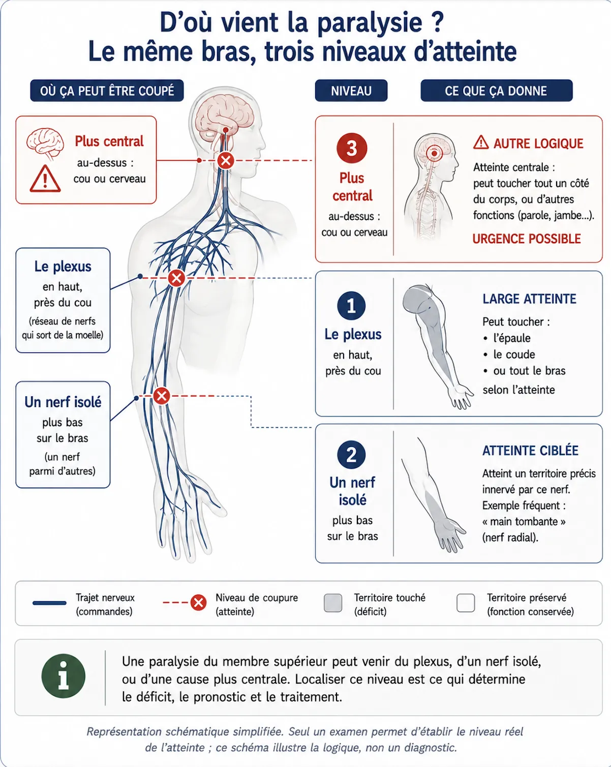 Paralysies du membre supérieur et Inférieur — illustration médicale