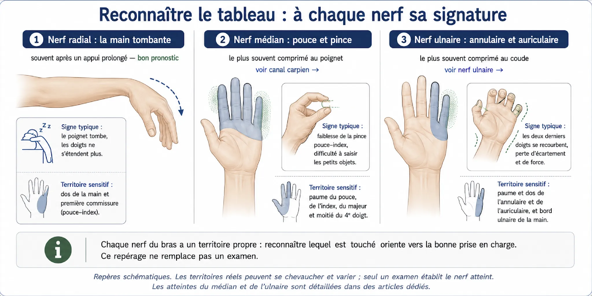 Paralysies du membre supérieur et Inférieur — illustration médicale