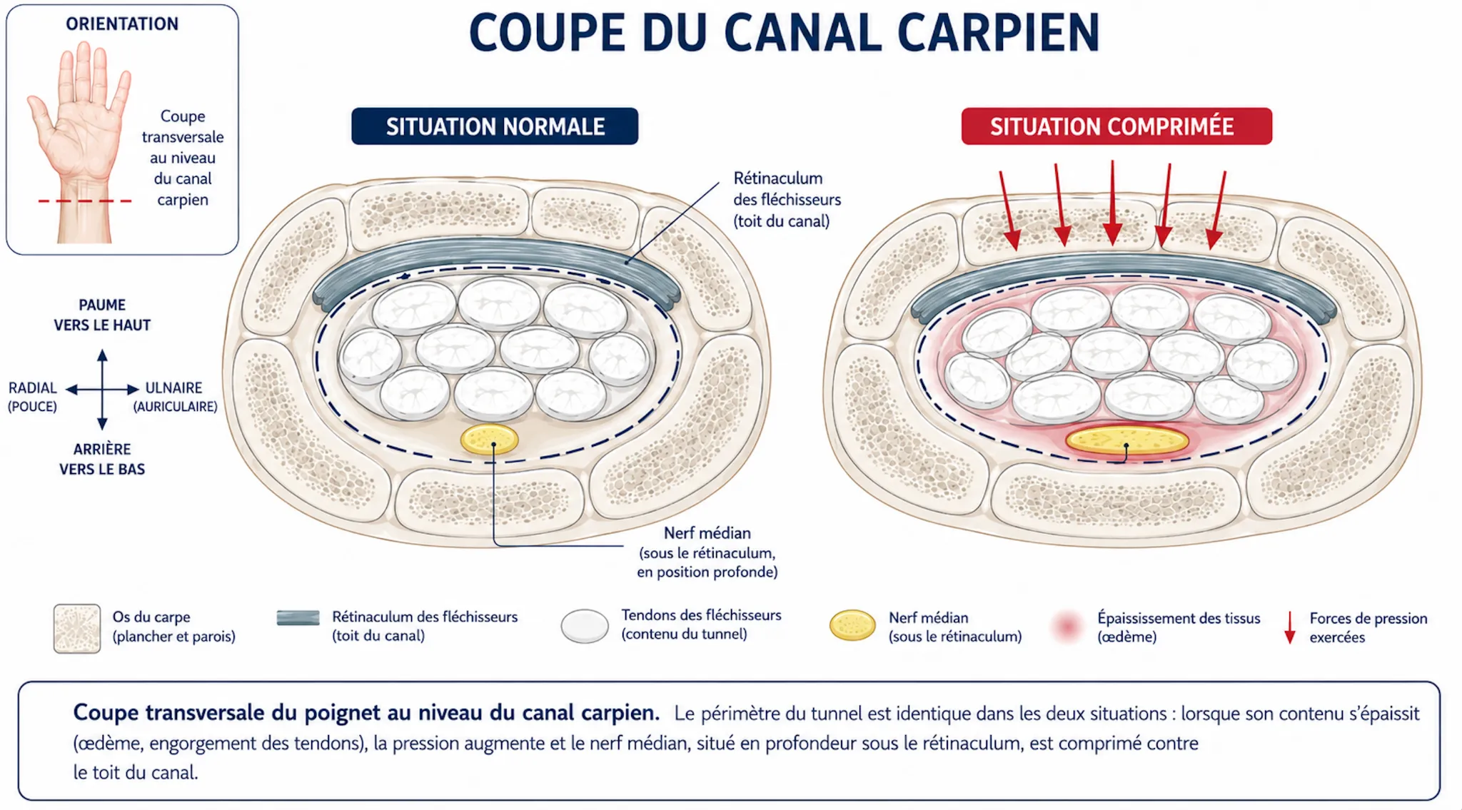 Syndrome du canal carpien — illustration médicale