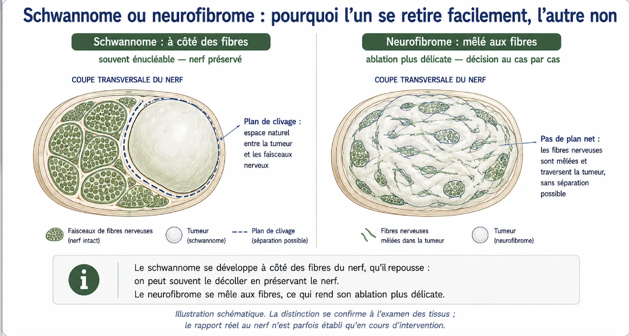 Tumeurs des nerfs — illustration médicale