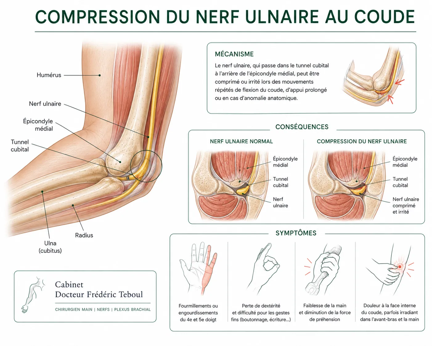 Compression du nerf ulnaire au coude : tunnel cubital, mécanisme et symptômes — Dr Frédéric Teboul, chirurgien spécialiste de la main et des nerfs à Paris