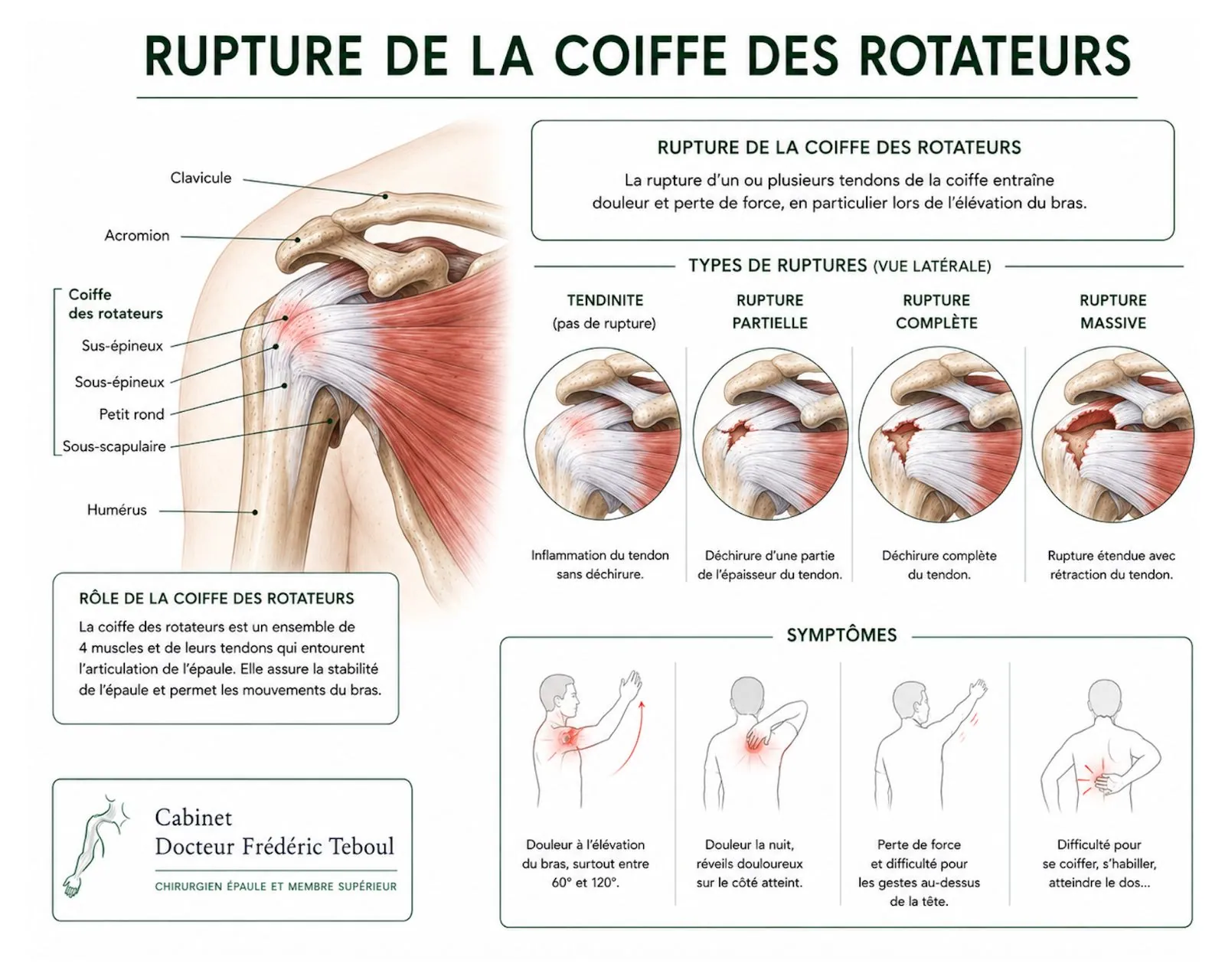 Rupture de la coiffe des rotateurs : anatomie des tendons, types de ruptures et symptômes — Dr Frédéric Teboul, chirurgien spécialiste de la main et du membre supérieur à Paris