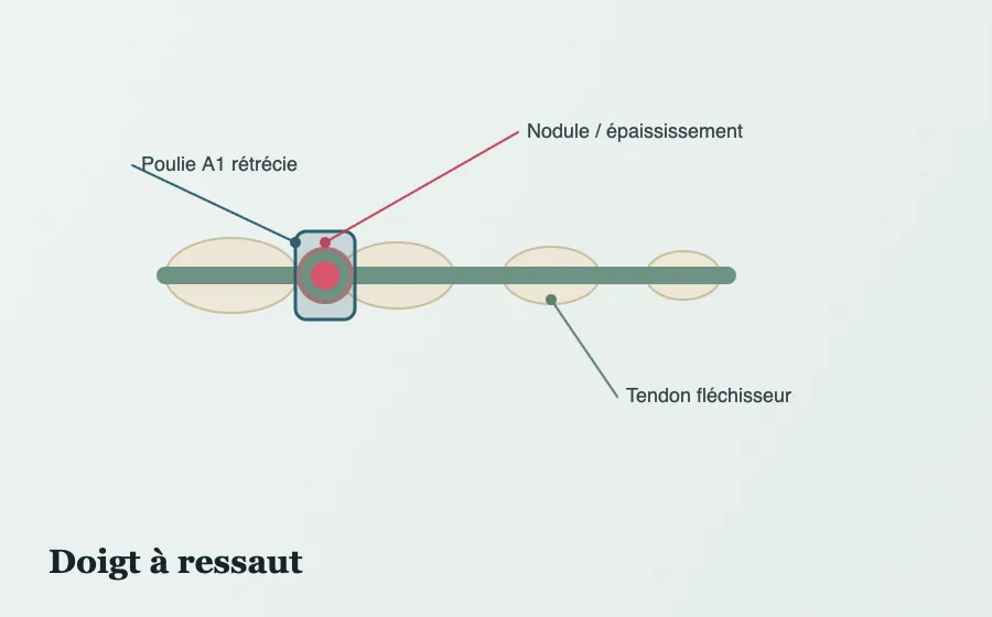 Schéma du doigt à ressaut : conflit entre le nodule du tendon fléchisseur et la poulie A1