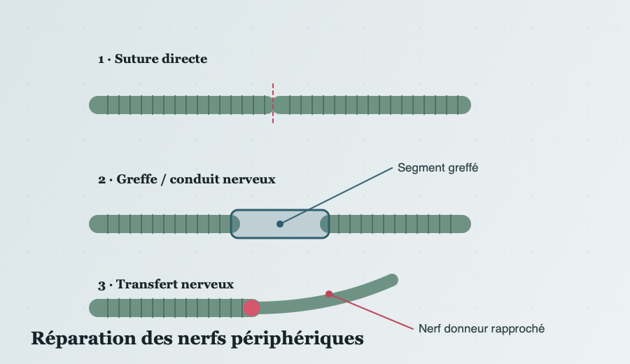 Schéma des trois stratégies de réparation nerveuse